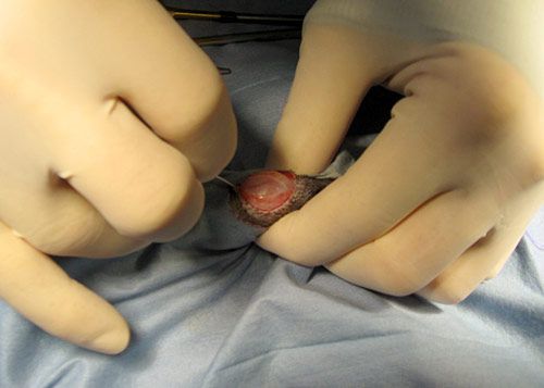 Making the skin incision
