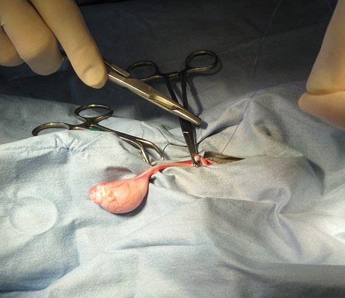 Transfixing suture is tied